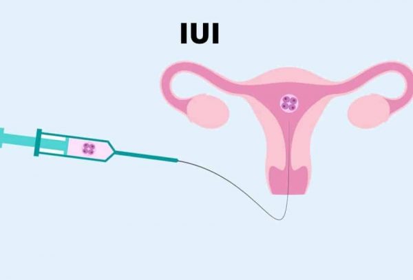 Đa số các trường hợp rối loạn đều được chỉ định thực hiện phương pháp kích thích buồng trứng.