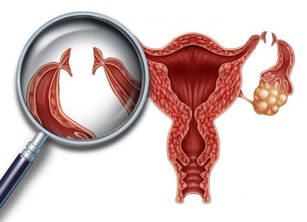 Có nên thắt ống dẫn trứng sau sinh mổ không còn phụ thuộc vào các yếu tố như tình trạng hay mong muốn của chị em