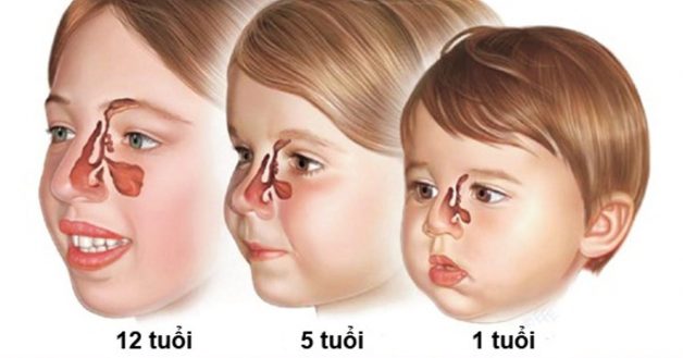 Có nhiều nguyên nhân gây ra bệnh viêm xoang mũi ở trẻ