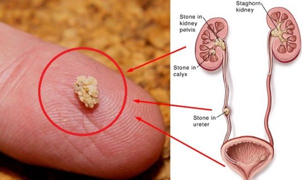 Tán sỏi niệu quản mất bao nhiêu tiền?