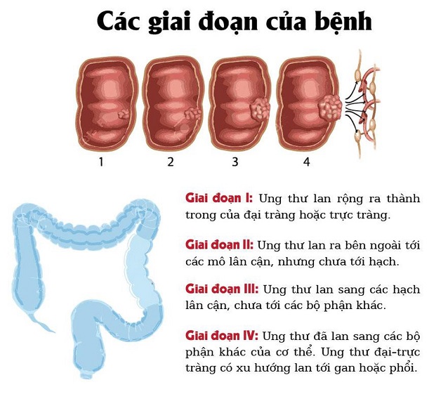 dấu hiệu ung thư đại tràng giai đoạn đầu