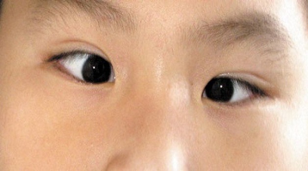 liệt dây thần kinh sọ não