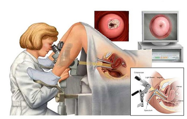 Chi phí điều trị bệnh ung thư cổ tử cung phụ thuộc vào giai đoạn bệnh, phương pháp điều trị,....