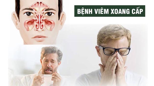viêm xoang mũi cấp là gì