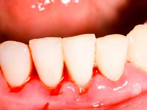 Triệu chứng chảy máu răng sẽ xảy ra khi bệnh nhân bị viêm nướu răng