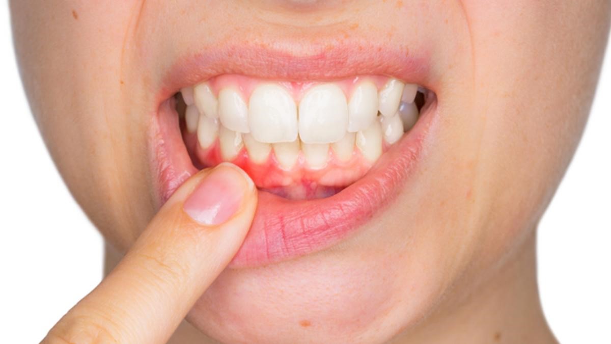 Lợi có dấu hiệu bị sưng phồng, mềm và đỏ lên