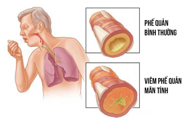 ngứa họng, khó thở