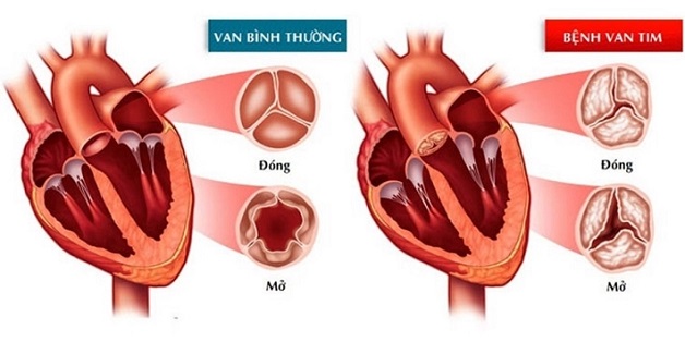 Hở van tim là tình trạng các van tim không thể đóng hoàn toàn khi co bóp, dẫn đến máu trào ngược lại buồng tim.