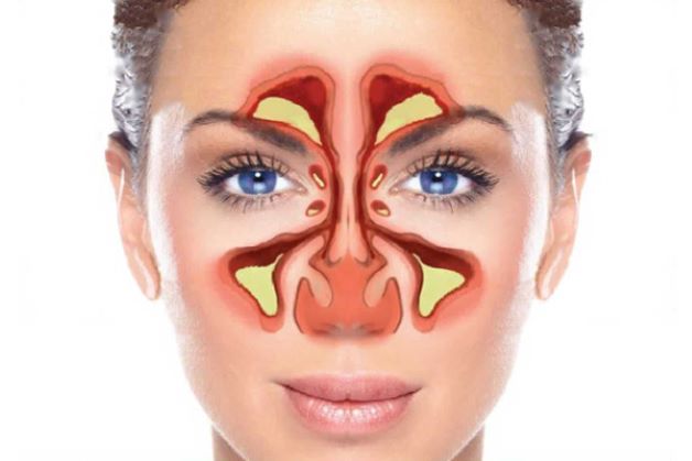 cách điều trị viêm xoang mũi