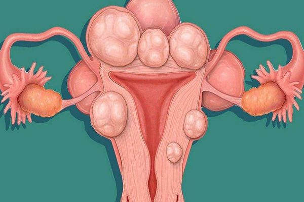 Với khối u xơ có kích thước lớn, chiếm toàn bộ diện tích buồng tử cung gây chèn ép lên các bộ phận xung quanh cần áp dụng phẫu thuật để tránh những biến chứng nguy hiểm