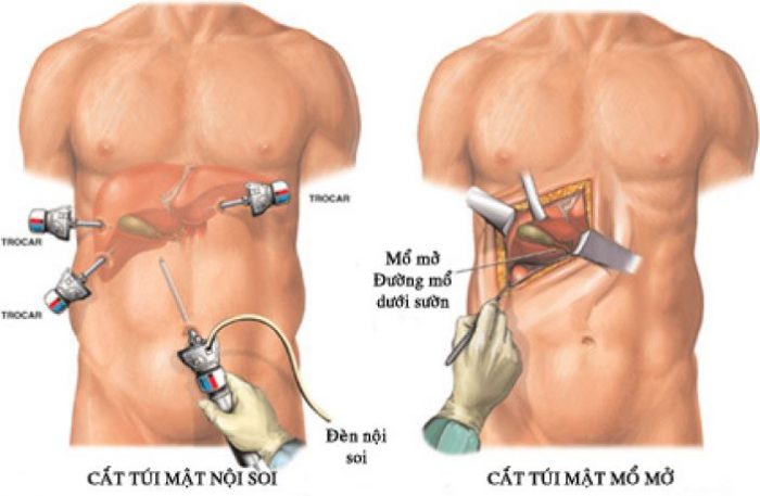 Mổ nội soi viêm túi mật nhiều ưu điểm