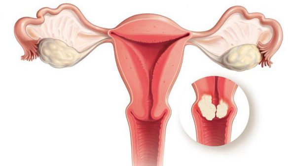 Nhìn chung, đa phần các khối u xơ tử cung đều lành tính, tuy nhiên vẫn còn tồn tại một số trường hợp có biến chứng ảnh hưởng tới sức khỏe sinh sản của chị em phụ nữ