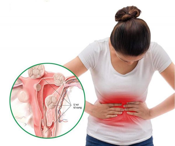 Đau bụng được xem là một trong những triệu chứng điển hình của u xơ tử cung