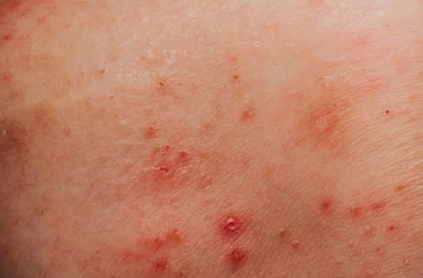 Mụn rộp sinh dục là một loại bệnh lây truyền qua đường tình dục