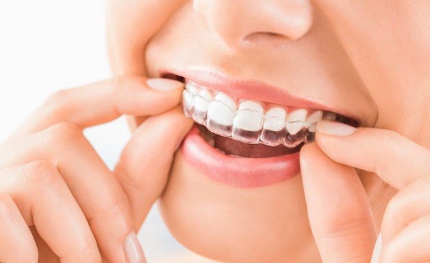 Niềng như không niềng là một trong những ưu điểm lớn nhất của phương pháp nắn chỉnh răng hô Invisalign.