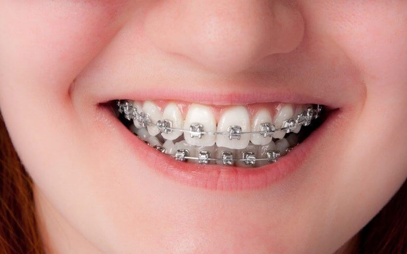 Niềng răng mắc cài kim loại