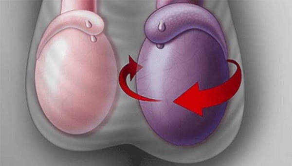 Teo hoặc co rút tinh hoàn là một trong những dấu hiệu phổ biến của giãn tĩnh mạch thừng tinh
