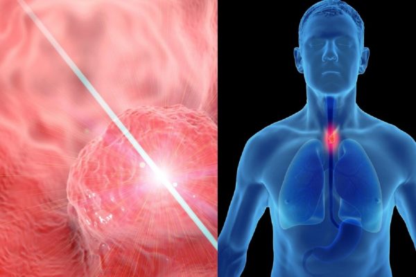 Nhận biết dấu hiệu ung thư dạ dày thực quản 