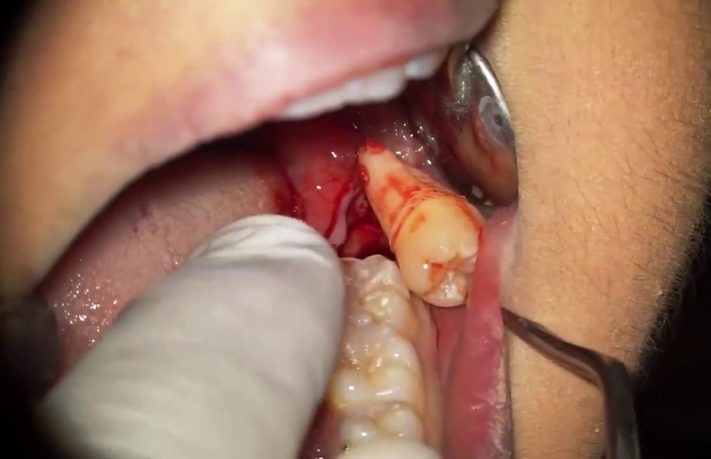 Nhổ răng khôn 1 chân thường ít đau hơn răng 2 chân, 3 chân