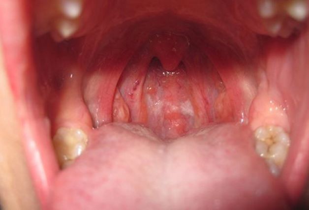 Viêm họng cấp là bệnh rất phổ biến và hầu như ai cũng đã từng mắc phải, thậm chí có người bệnh đã trở thành mãn tính, gây khó khăn cho quá trình điều trị.