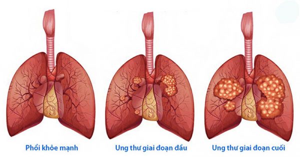 Phổi bị tàn phá qua các giai đoạn của bệnh ung thư phổi
