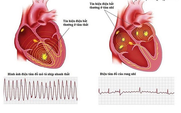 Điện tâm đồ là phương pháp phổ biến để chẩn đoán rối loạn nhịp tim.