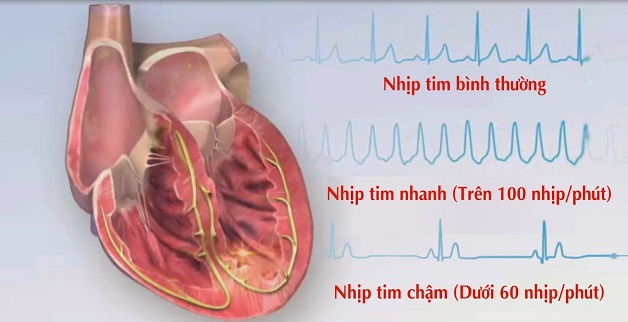 Rối loạn nhịp tim có nguy hiểm không còn phụ thuộc vào dạng rối loạn, nguyên nhân gây loạn nhịp và các bệnh lý đi kèm.