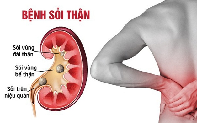 Tán sỏi thận hết bao nhiêu tiền phụ thuộc vào nhiều yếu tố khác nhau