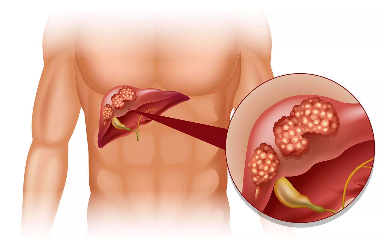 TIÊU CHUẨN CHẨN ĐOÁN UNG THƯ GAN BAN HÀNH BỞI BỘ Y TẾ