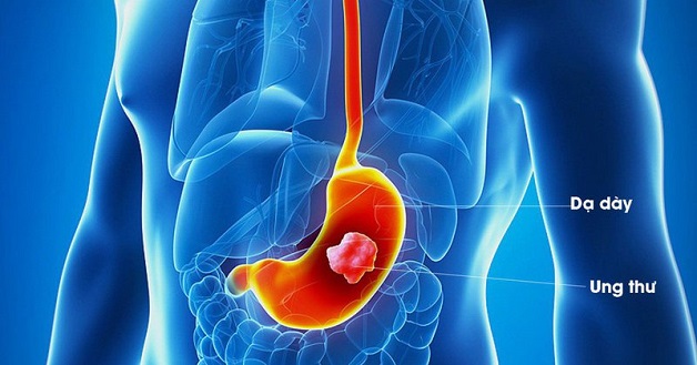 Nguyên nhân và cách điều trị ung thư dạ dày như thế nào