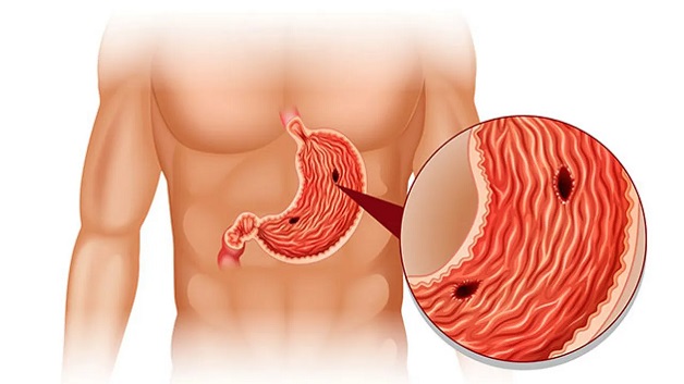 Nguyên nhân và cách điều trị ung thư dạ dày - viêm dạ dày