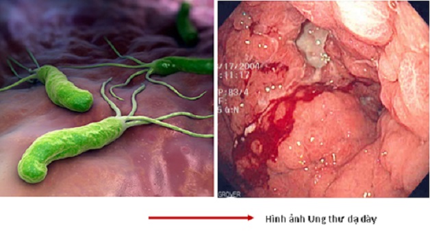 tìm ra nguyên nhân và dấu hiệu ung thư dạ dày 