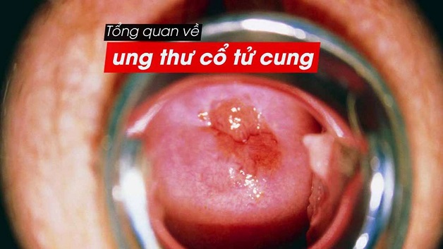 Ung thư cổ tử cung là căn bệnh nguy hiểm thường mắc ở phụ nữ trên 35 tuổi.