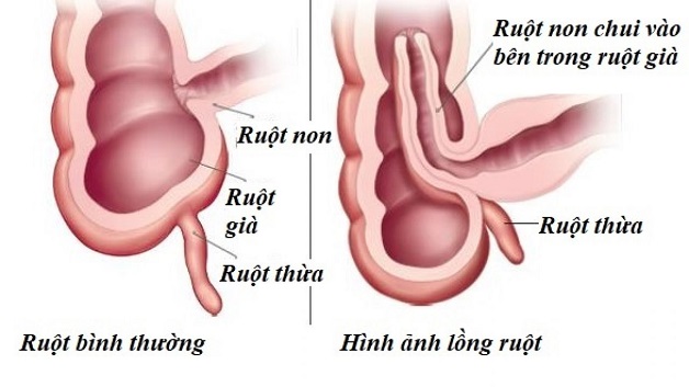 trẻ bị lồng ruột là gì