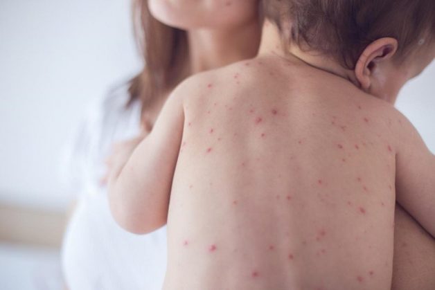 Trẻ bị sốt phát ban do virus tấn công và gây ra tình trạng nổi các ban đỏ như: virus sởi, Rubella hoặc virus đường ruột Echo gây ra.