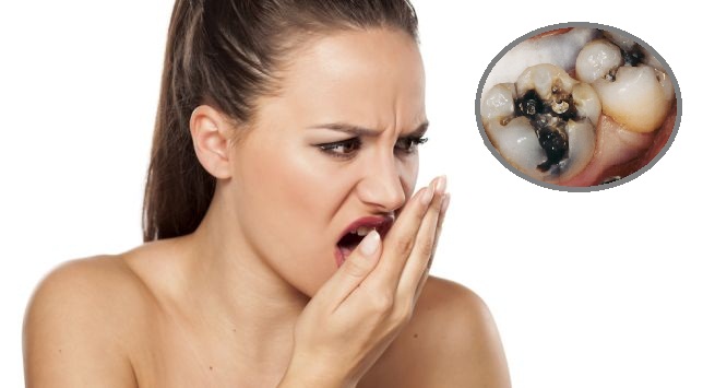 Hôi miệng sâu răng ảnh hưởng rất lớn đến sinh hoạt hằng ngày của người mắc phải và người xung quanh