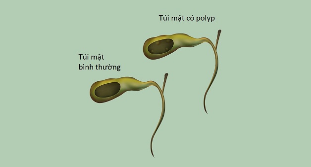 Các triệu chứng polyp túi mật