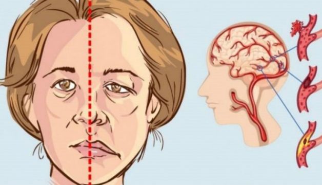 Một trong các triệu chứng là miệng người bệnh bị méo lệch sang một bên