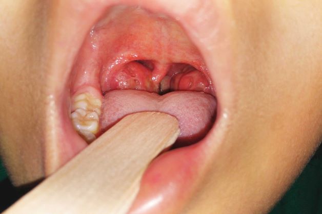 Viêm amidan thường gặp nhất là ở trẻ nhỏ và thường hiếm gặp ở trẻ em trước 2 tuổi, bệnh sẽ tự khỏi sau 3–4 ngày mà không cần điều trị.