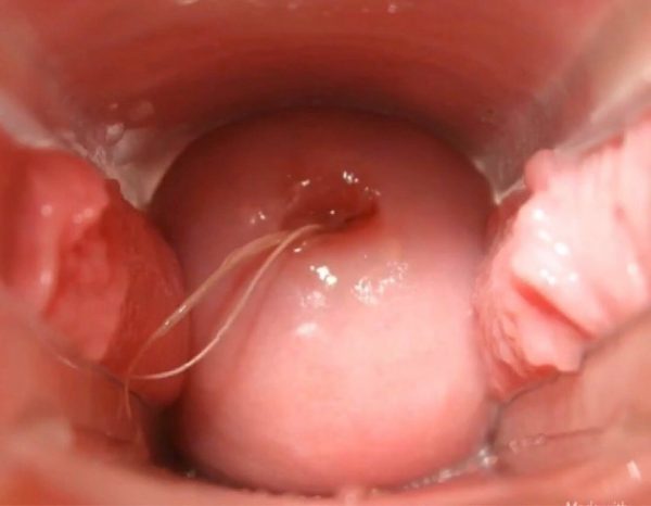 Viêm cổ tử cung là tình trạng sưng, viêm hoặc lở loét ở cổ tử cung, bệnh do các tác nhân như nhiễm khuẩn, nấm hay ký sinh trùng gây ra.