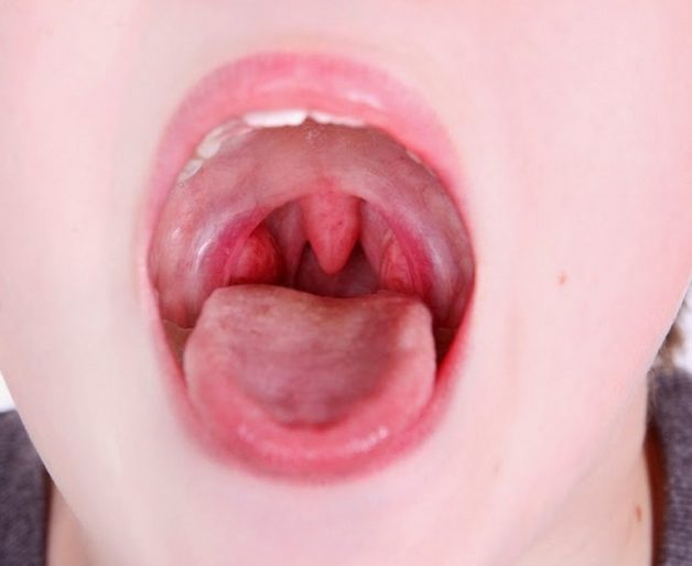 Viêm họng cấp là bệnh thường gặp ở trẻ em