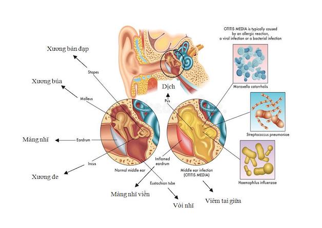 Có rất nhiều nguyên nhân có thể gây ra bệnh viêm tai giữa trẻ em.