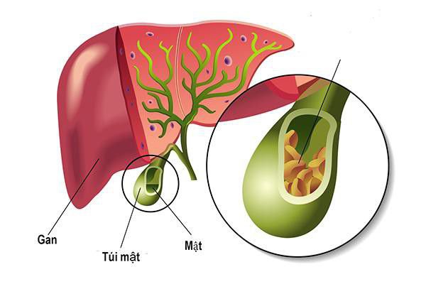 Viêm túi mật xơ teo là gì