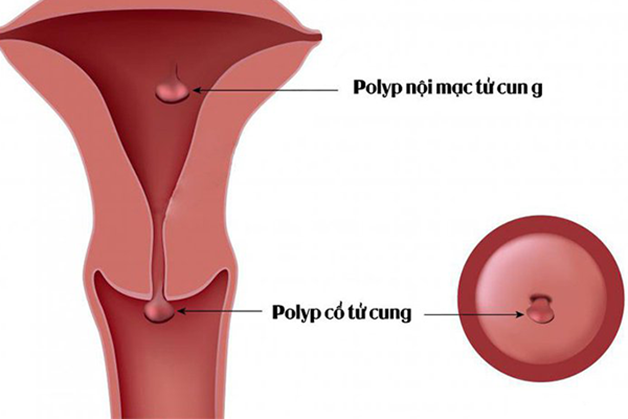Cắt polyp cổ tử cung hết bao nhiêu tiền