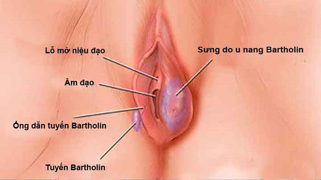 Hình ảnh viêm tuyến Bartholin