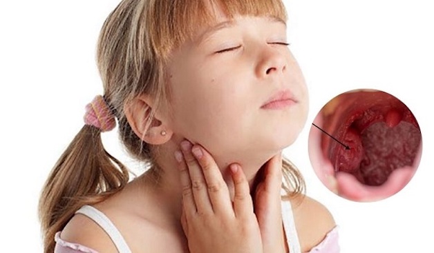 tìm hiểu bệnh amidan quá phát