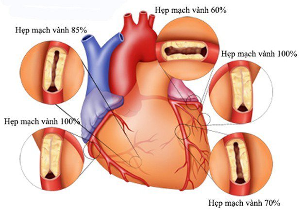 Bệnh hẹp động mạch vành có nhiều mức độ, là tình trạng cholesterol trong máu lắng đọng lại ở thành mạch vành.