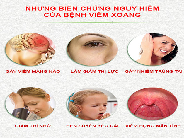 Bệnh viêm xoang mũi có nguy hiểm không khi dễ xảy ra nhiều biến chứng.