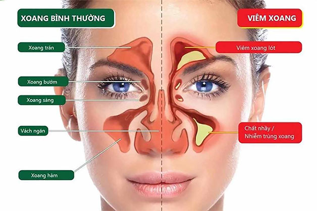 Viêm xoang là tình trạng lớp niêm mạc của xoang bị viêm, sưng phù dẫn đến làm tắc nghẽn các lỗ thông xoang.