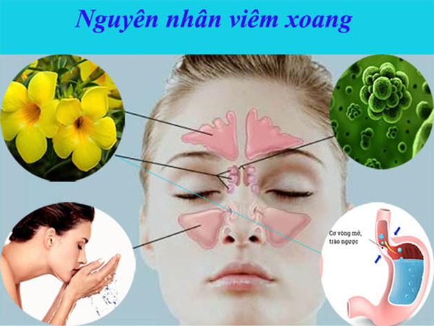 Tổng hợp một số nguyên nhân phổ biến dẫn đến viêm xoang.